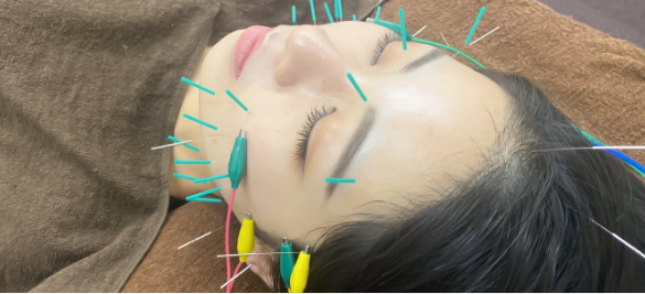 美容鍼コース